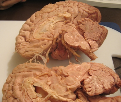 Brain 1 (B1): Brain Tissue, Nuclei, Fluid & Autonomic Nervous System